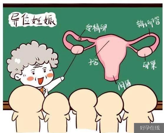 试管婴儿宫外孕