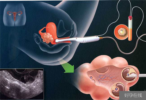 胚胎移植流程图
