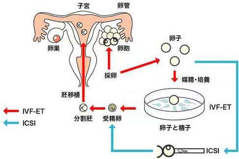 什么叫体外授精