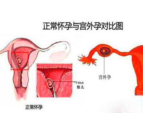 正常怀孕与宫外孕对比图