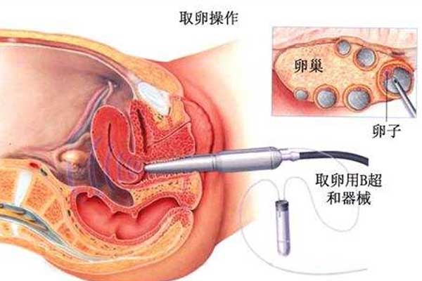 试管婴儿取卵痛不痛