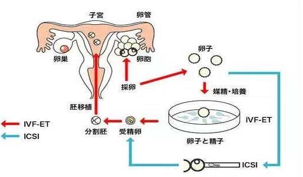 试管婴儿流程示意图