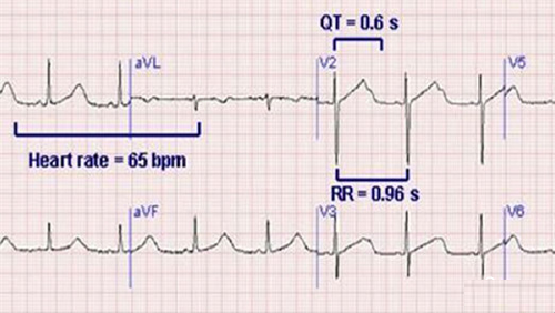 QT间期延长综合症心电图