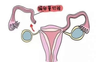 合肥慈铭博鳌国际医院三代试管婴儿，切除双侧输卵管还能做试管婴儿吗？